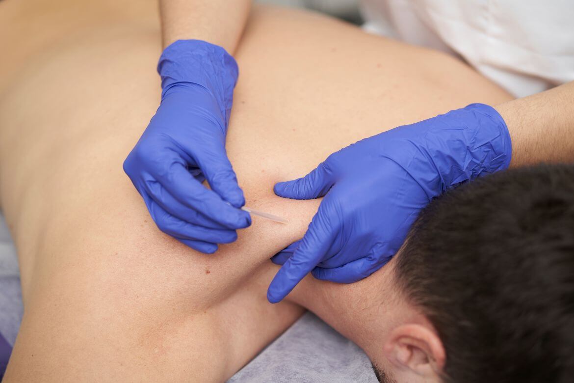 Dry Needling Treatment in Pune